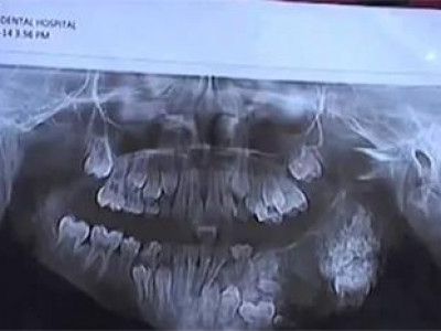 Долоон настай хүүгийн 80 шүдийг авчээ