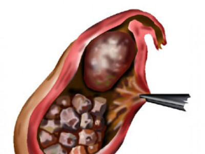 Цөс чулуужих өвчин гэж юу вэ?