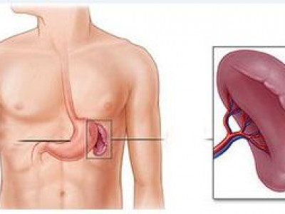 Цөс чулуужих өвчний үндсэн “эмчилгээ” ба “сэргийлэх” арга