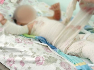 Бага насны хүүхэд түлэгдсэн дуудлага их иржээ 