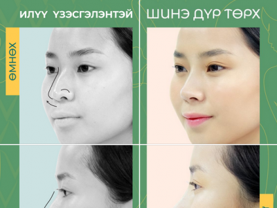 Жүжигчин Ц.Номингийн шинэ хамар