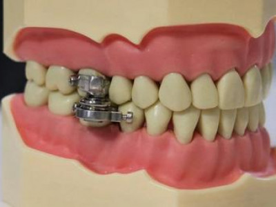 Aмаа тvгжээд их хоол идэж чaдахгүй болох төхөөрөмж зохион бүтээжээ