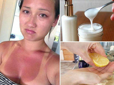 Борлож, түлэгдсэн арьсыг гэрийн нөхцөлд цайруулах шилдэг аргууд